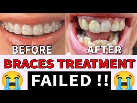 failed braces result